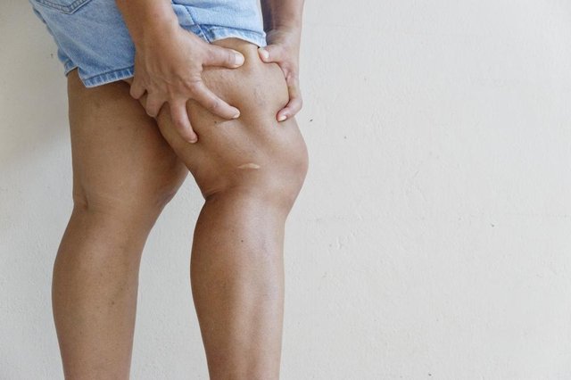 Best Doctor for Varicose Veins in Delhi NCR